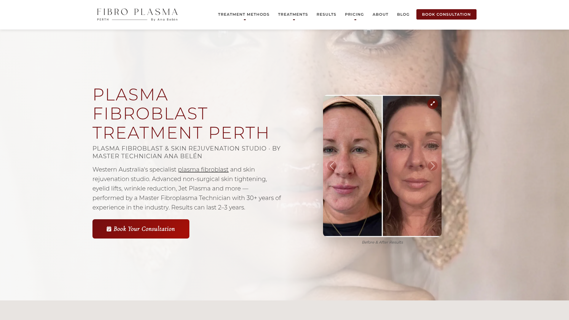 Fibro Plasma Perth